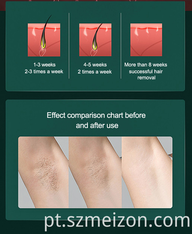 soprano ice laser hair removal brighton